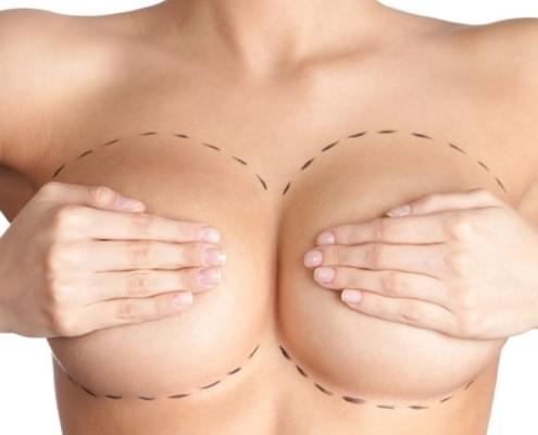 breast-reconstruction-575x560-495x400